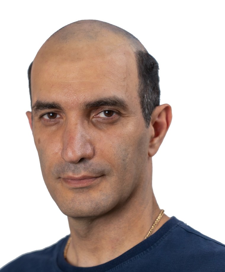 Berham before — hair loss, before Gen'C hair system