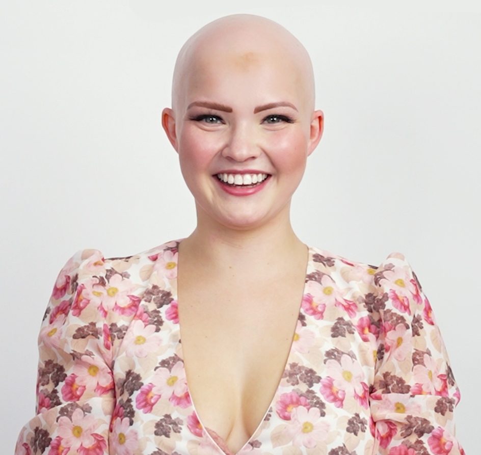 Marcy before, hair loss due to alopecia